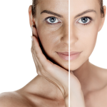 Cách phân biệt nám da với tàn nhang